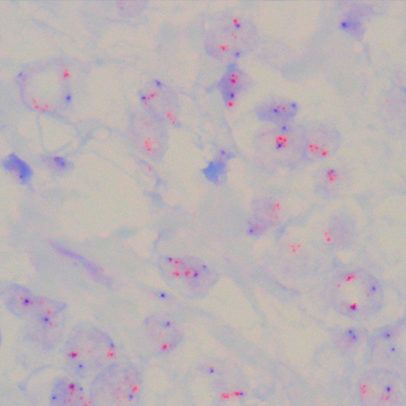 O Imagepat realiza exame molecular para pesquisa de amplificação do gene HER2